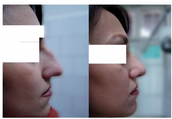 rinoplastie